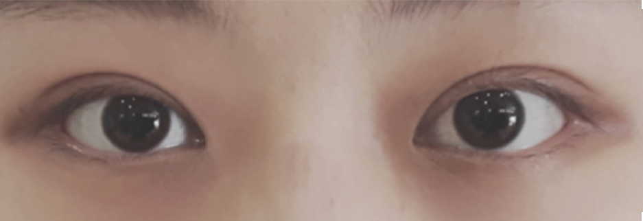 After: Non incisional double eyelid with ptosis correction, one month after surgery
