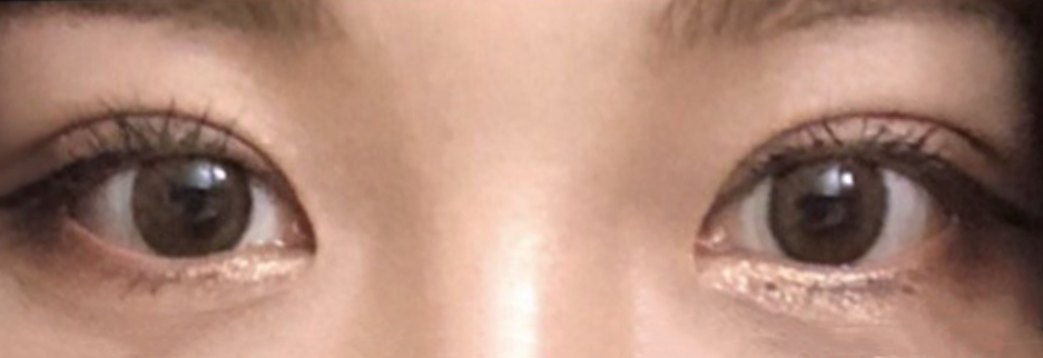After: Incisional ptosis correction with lateral canthoplasty, one month after surgery