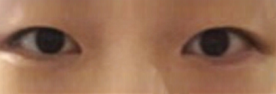 Before: Incisional ptosis correction with lateral canthoplasty, one month after surgery