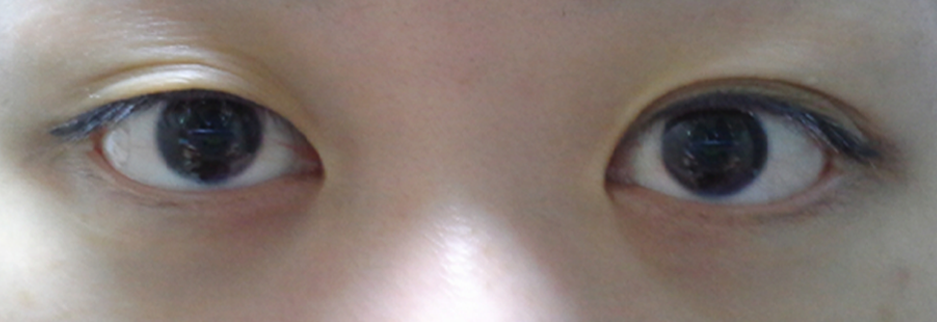 Before: Revision surgery for a loosened fold, one month after surgery
