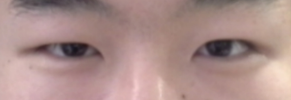 Before: Men's incisional ptosis correction, two months after surgery
