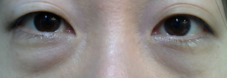 Before: Under eye fat repositioning, one month after surgery